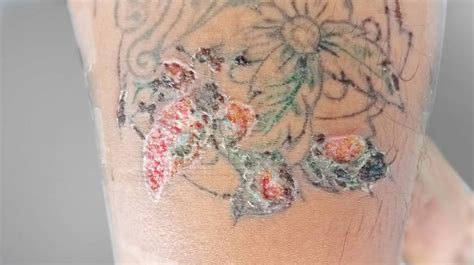 Uncovering the Dark Charm of Black Ink Infected Tattoo: Exploring the Risks and Rewards of this Bold Body Art Trend