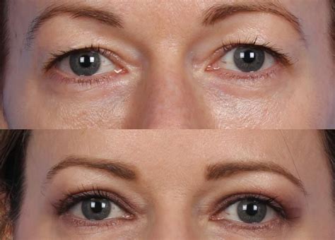Blepharoplasty: The Definitive Fix