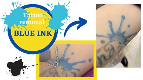 Tattoo Removal Toronto,can tattoos be removed tattoo