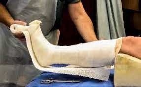 Body Cast Care: Tips for Fast Healing.