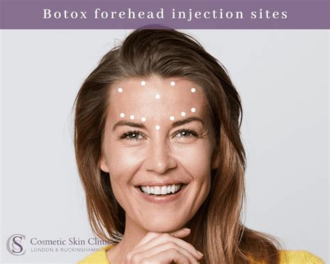 Botox Forehead Conclusion
