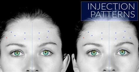 Botox Injection Patterns