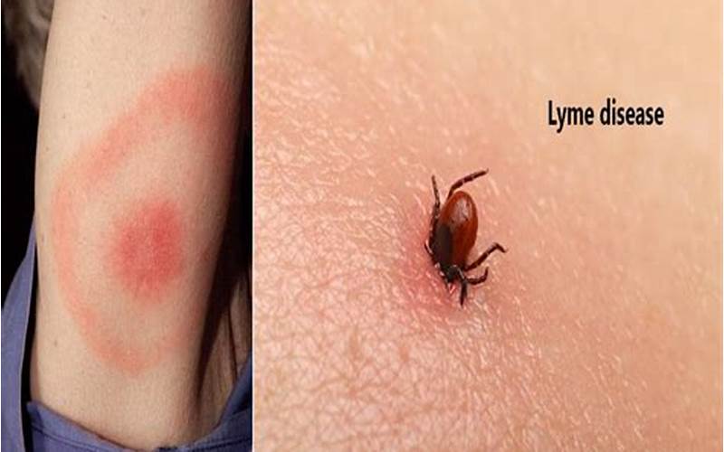 Bout With Lyme Disease