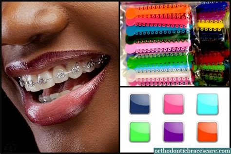 Unleashing the Magic of Braces: A Guide to Finding the Perfect Color for Dark Skin