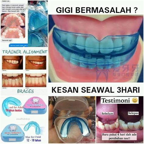 Pinjam Cena untuk Senyuman Cantik dengan Braces Murah Terbaik di Malaysia