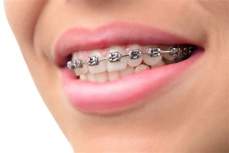 Braces, veneers, and dental implants