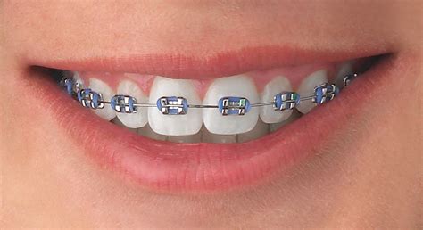 Brackets De Color Blanco