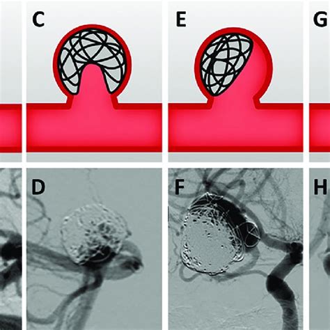 Brain Aneurysm Inheritance Patterns