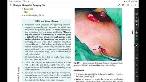 Breast Abscess Surgery: Options & Recovery