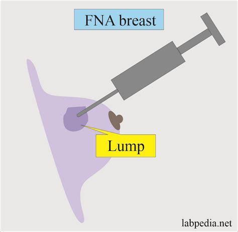 Breast FNA Test and interpretation