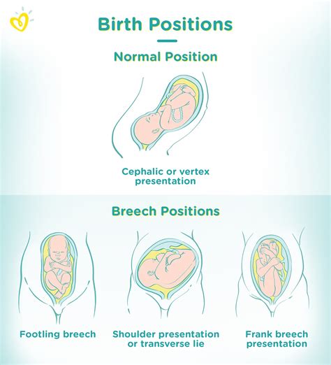 Breech Birth: Safe Delivery & Avoiding Risks