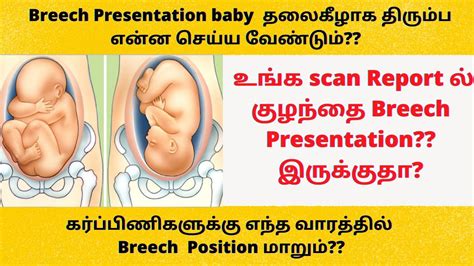 36 Weeks Pregnant My Baby Is Breech I Feel Hisnhead Sticking Out Can