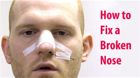 Broken Nose Medical Treatment