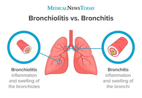 Bronchiolitis vs Bronchitis: Key Differences