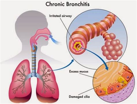 7 Metode Pengobatan untuk Bronkitis Kronis • Hello Sehat