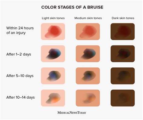 Bruising Color Chart