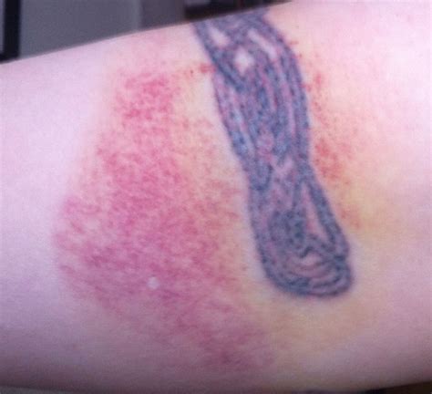 Bruising From A Tattoo