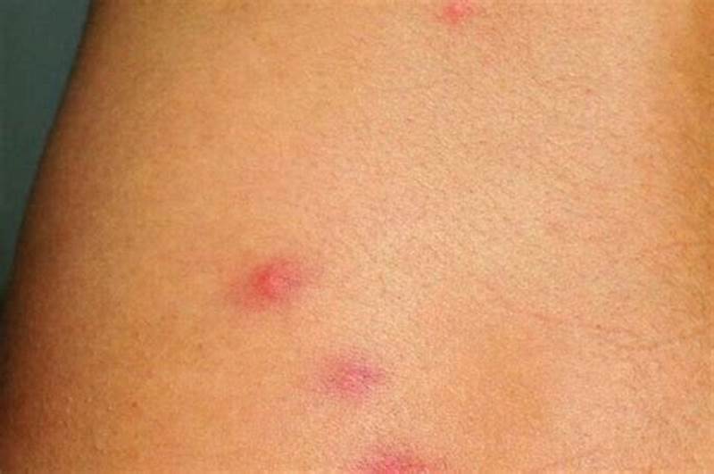 Bug Bites In Linear Pattern