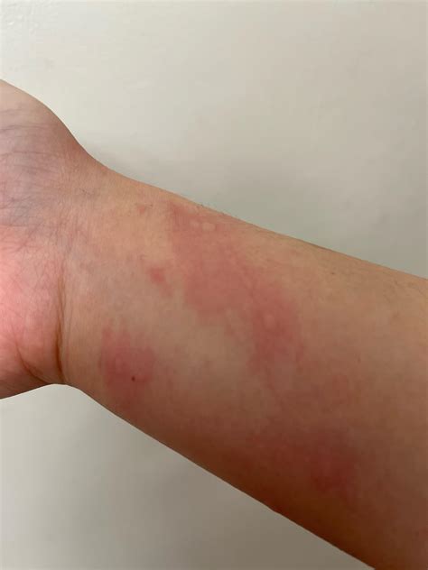 Sweat-induced Skin Woes: Decoding the Mystery of Bumps on Skin After Working Out