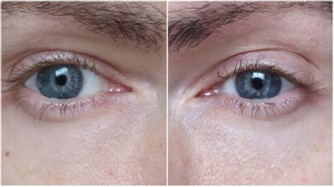 Smooth Your Troubled Soul: The Solution to Bumpy Skin Under Eyes