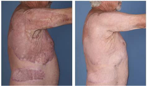 Burn Scars: Removal, Types & Healing Tips