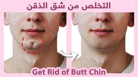 How to Smooth Out and Enhance Your Chin Contour: Tips for Minimizing the Appearance of a Cleft Chin