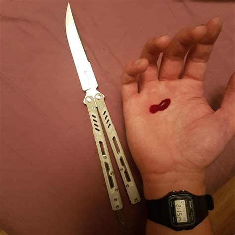 Butterfly Knife Injury