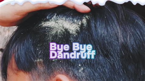 Bye Bye Neck Dandruff: Fast Relief Tips