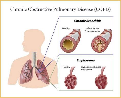 COPD & Oxygen Therapy: Breathe Easier Now.