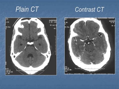 CT Scans: Contrast vs. Non-Contrast – Explained.