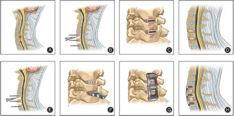 Cage Fusion and Plating with C-Arm Guidance