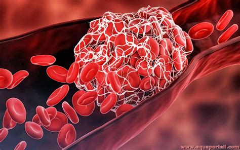 Caillot de Sang Post Partum