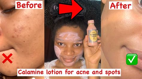 Discover the Transformative Skin-Whitening Benefits of Calamine Lotion!