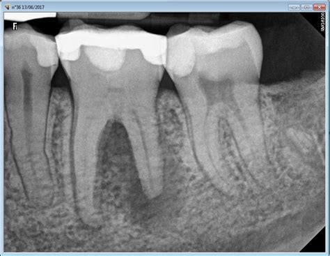 Calcified Tooth Root