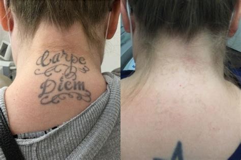 Gallery Absolute Laser Tattoo Removal San Diego, CA