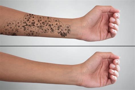 Can All Tattoos Be Removed? 6 Things You Should Know Dr