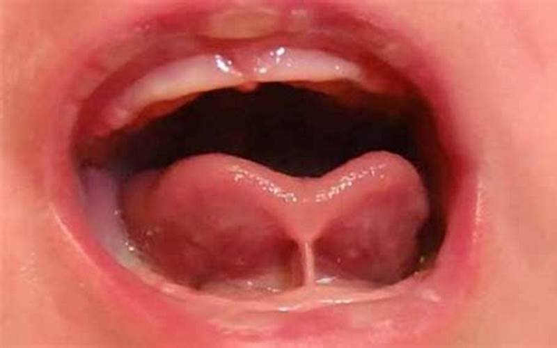 Can Tongue Tie Develop Over Time With Baby?