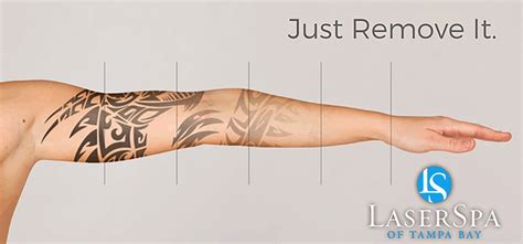 Can You Tattoo Over a LaserRemoved Tattoo? BareRemoval