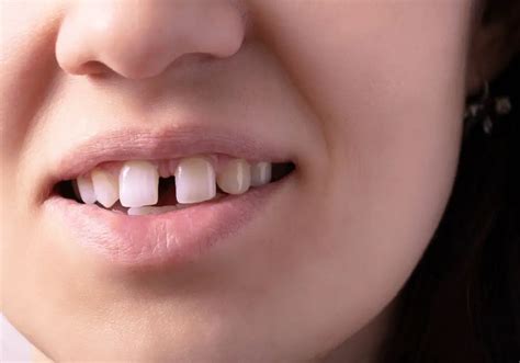 Can A Gap Form In Your Teeth