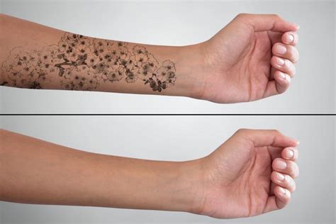 Can Tattoos Be Removed Completely? What You Need To Know