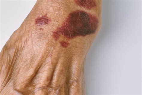Unveiling the Enigma: Untold Truths about Blood Stains on Skin - A Detailed Insight into the Processes of Blood Coagulation and Skin Absorption