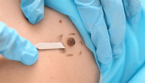 Unveiling the Secrets: How Estheticians Can Banish Skin Tags for Good