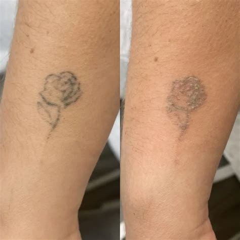 Can Tattoo Be Completely Removed