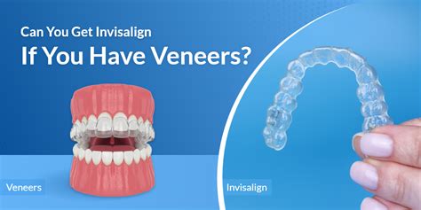 Can You Get Invisalign With Veneers