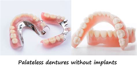 Can You Get Palateless Dentures Without Implants