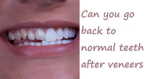 Can You Go Back To Normal Teeth After Veneers