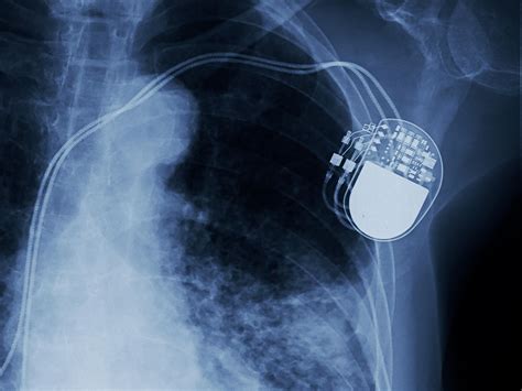 Can You Have A Cdl With A Pacemaker