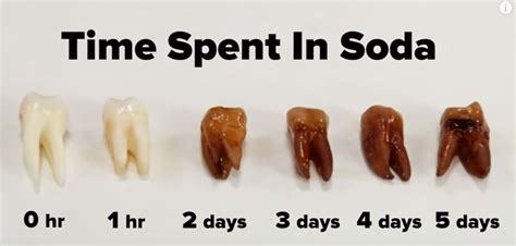 Can You Have Soda After Tooth Extraction