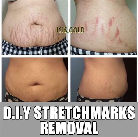 Can You Surgically Remove Stretch Marks