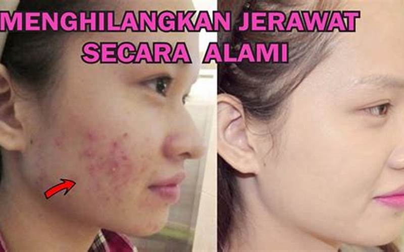 Cara Ampuh Hilangkan Bekas Jerawat Di Apotik